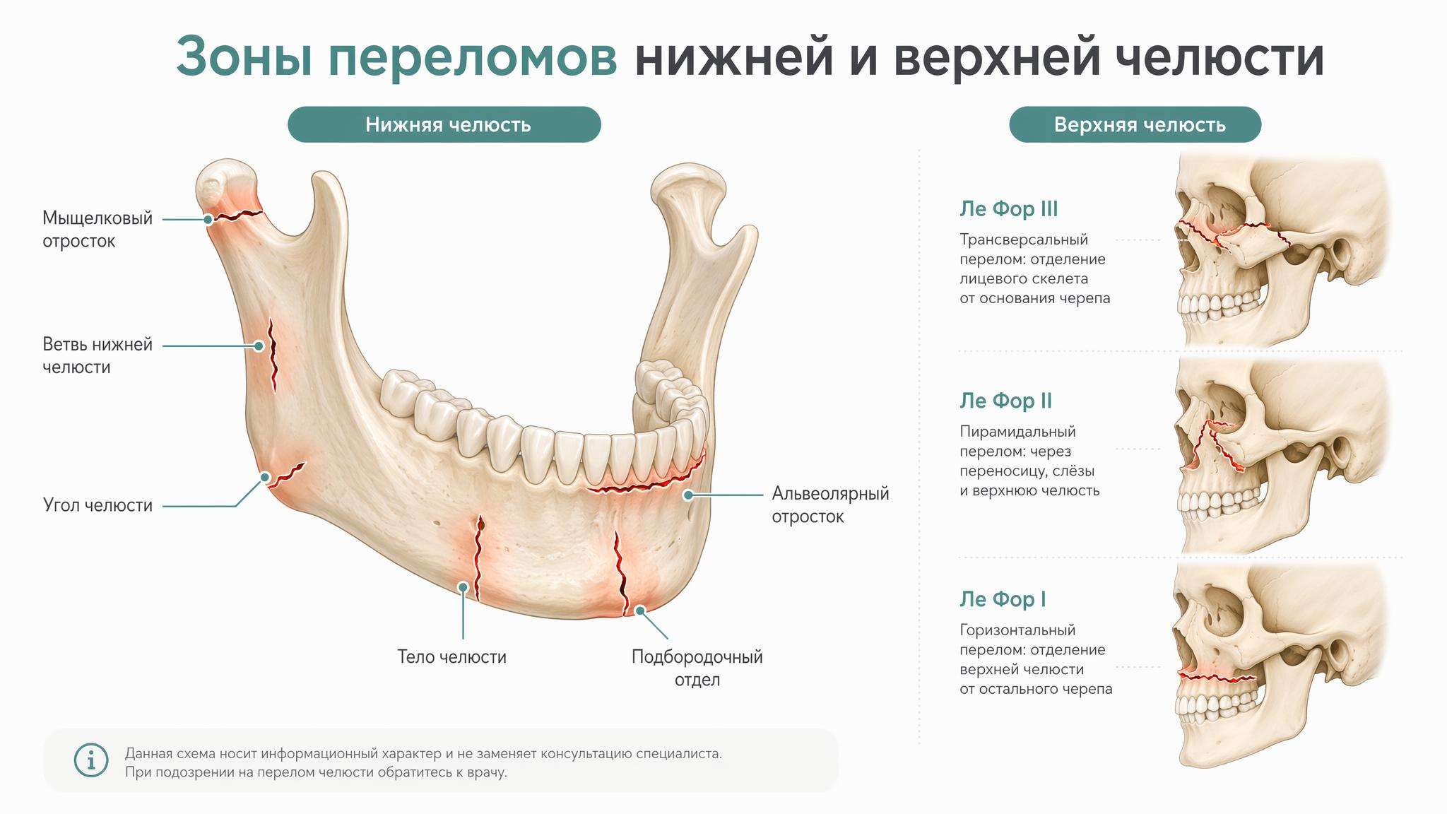 Анатомическая схема зон переломов нижней и верхней челюсти с обозначением мыщелкового отростка, угла, тела челюсти и типов Ле Фор.
